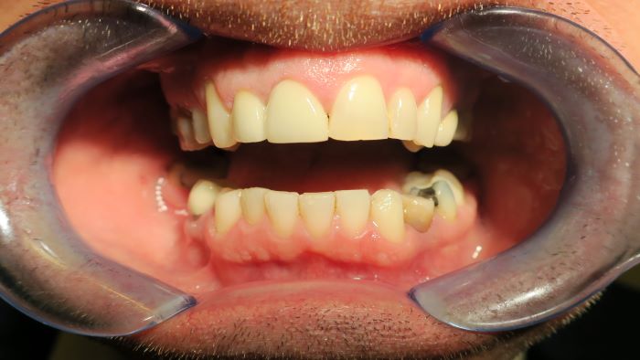 ceramic dental crowns
